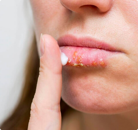 Impetigo