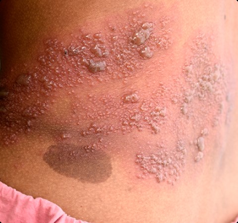 Shingles